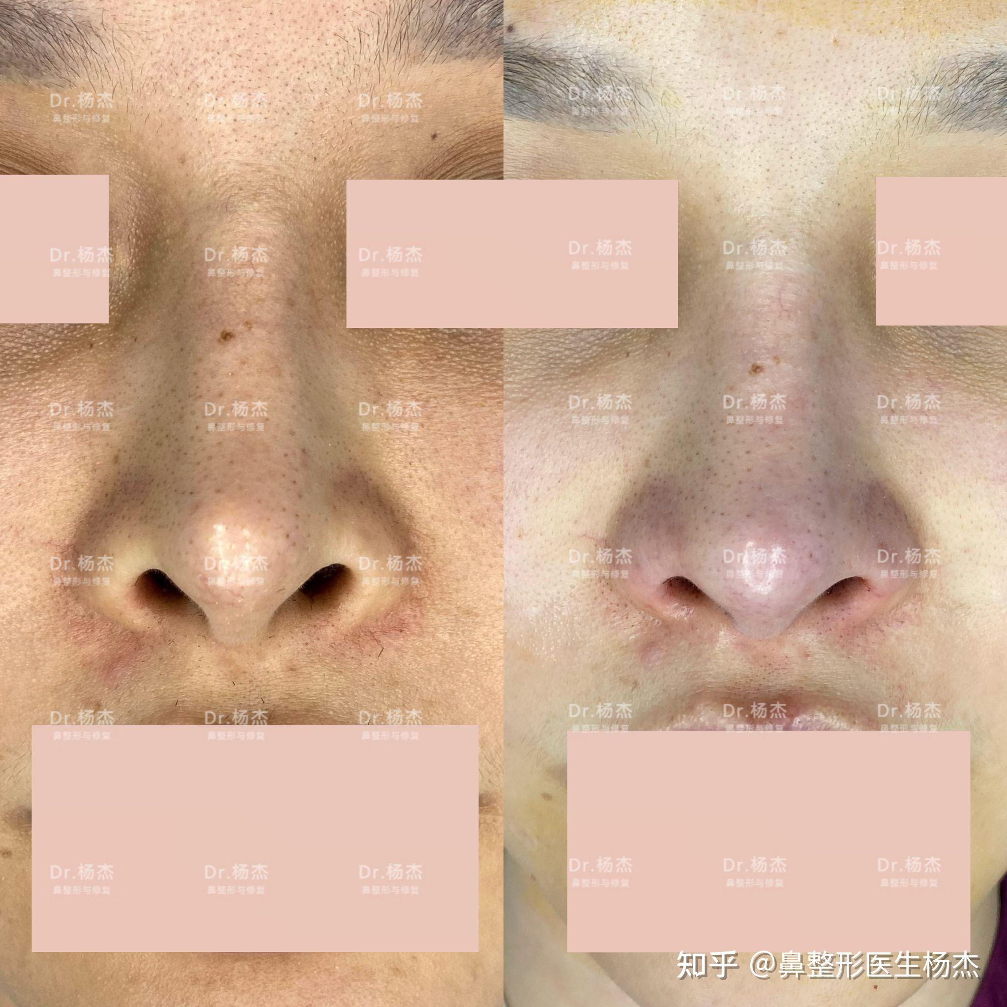 永井宏治 | 鼻尖修复+硅胶隆鼻+鼻翼缩小 - 知乎