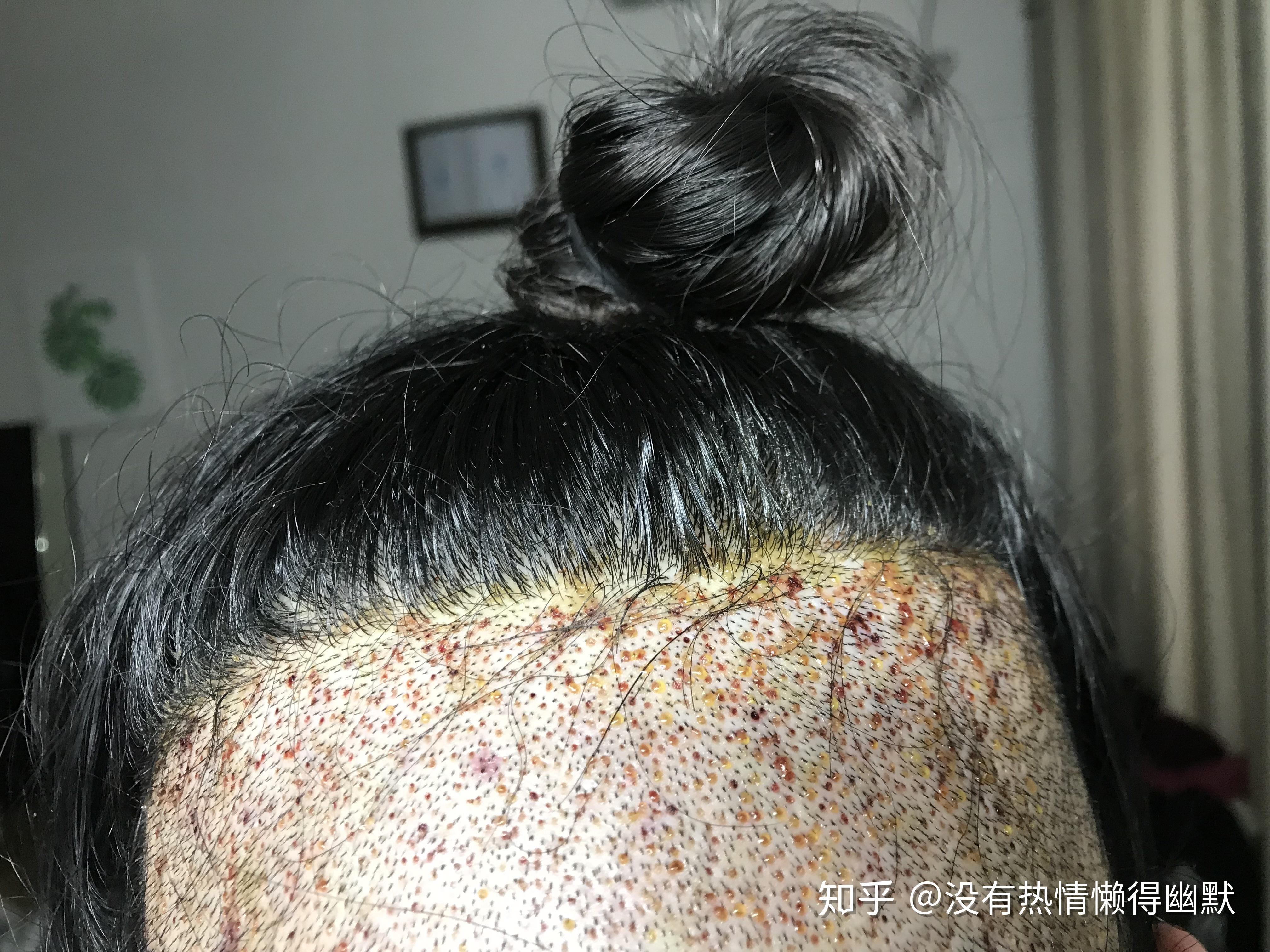 植发后下午晚上肿了(植发后下午晚上肿了怎么回事)