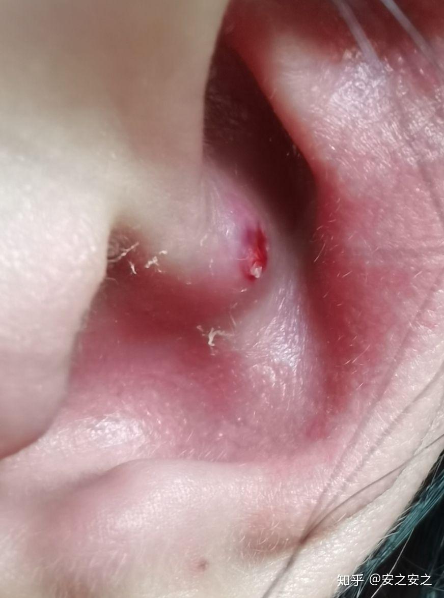 耳朵里长痘痘是一种什么体验? 