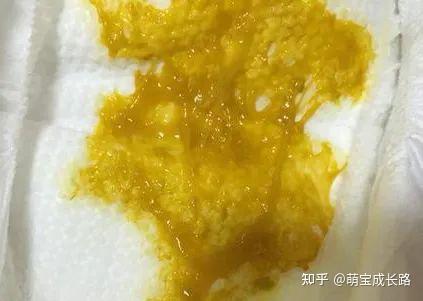 泡沫便 粘液便 绿便 宝宝各种性状及颜色的便便这里都有 知乎