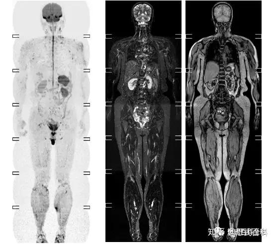 磁共振全身成像技术（一） - 知乎