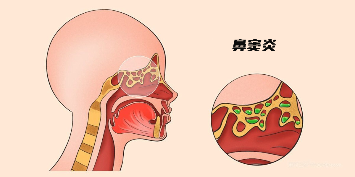 开刻立温馨提醒：别把鼻窦炎当“重感冒”！这些知识帮你避开误区 - 知乎