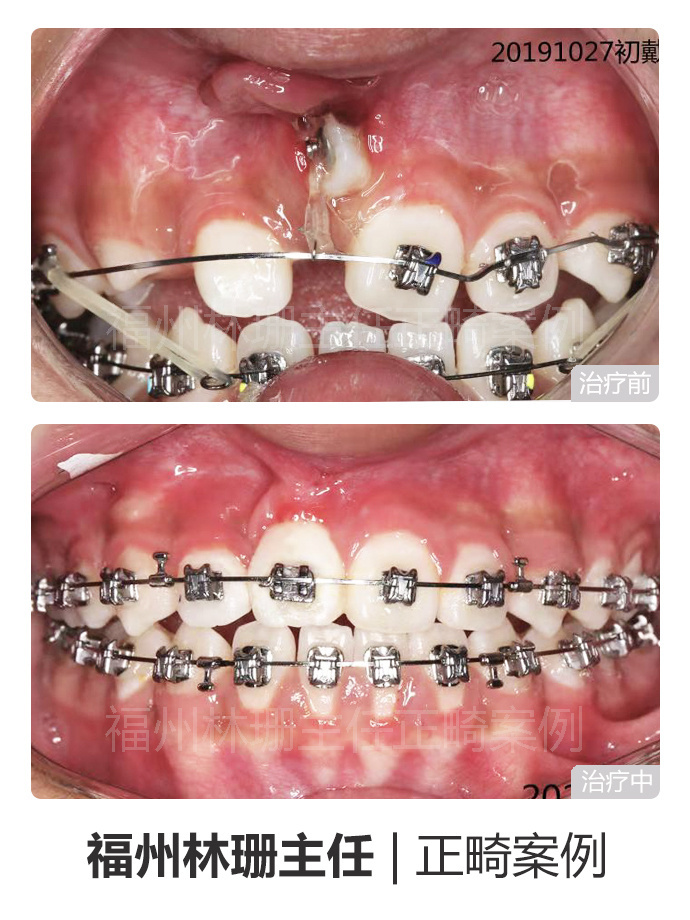 福州牙齒矯正丨8個月解決埋伏牙地包天高難度複雜病例