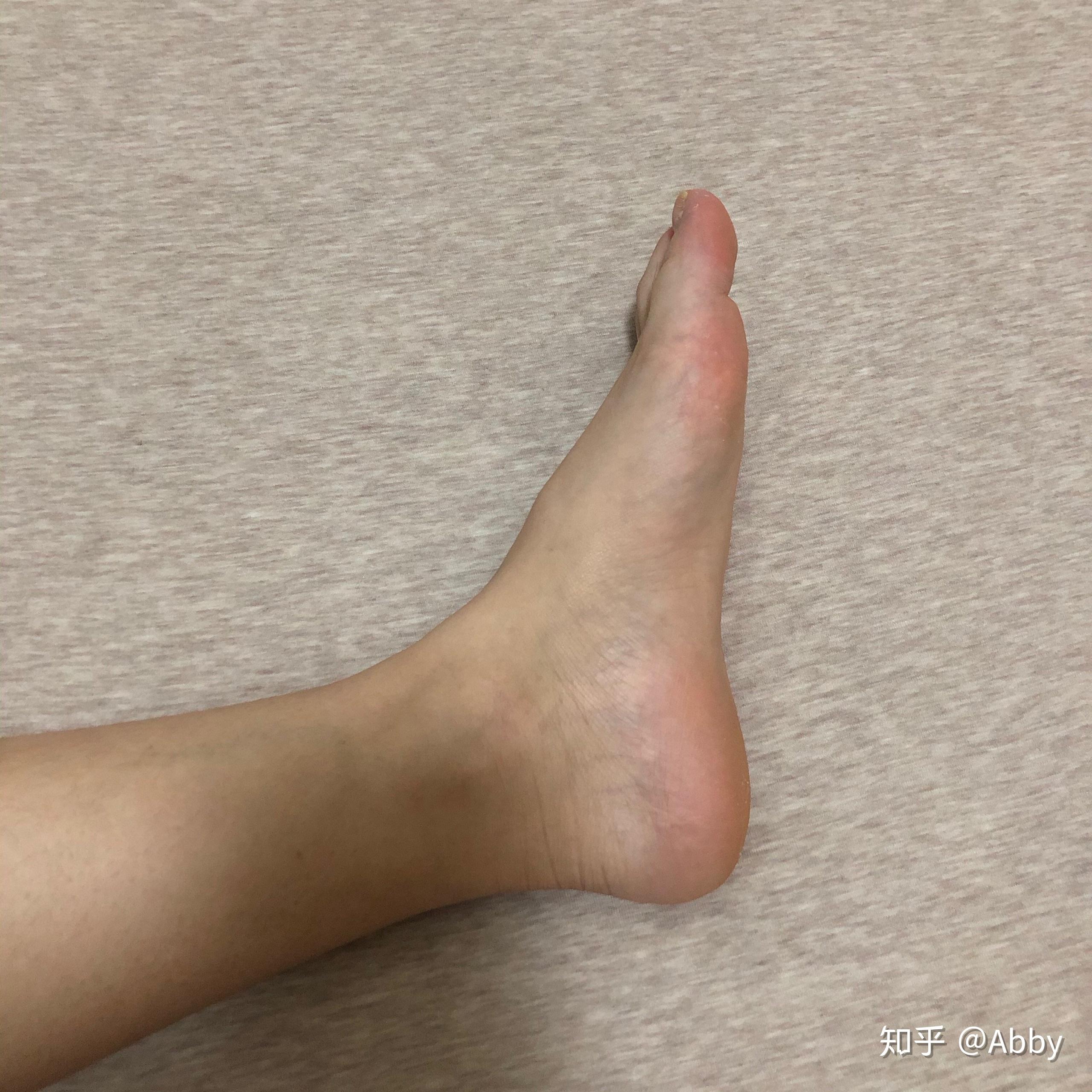 请问我这样的脚还能压脚背么?