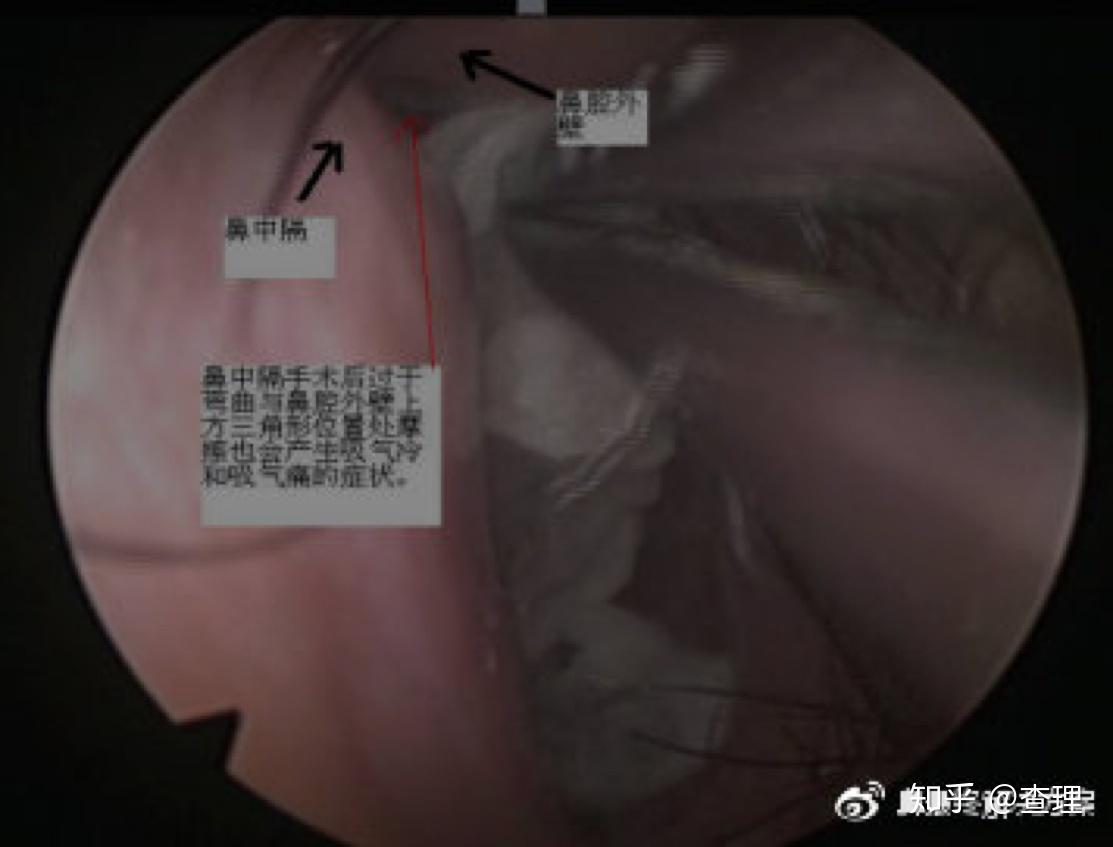 鼻堵的原理_鼻炎知识 找出鼻塞 鼻堵的 真凶 佛山市炏焱健康管理(2)