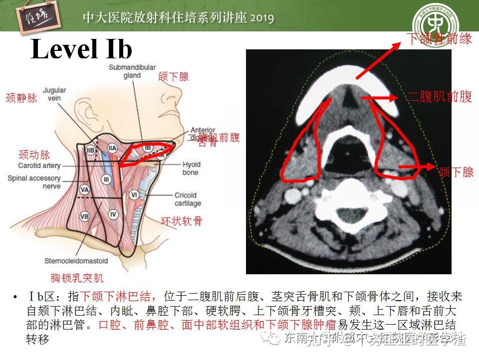 2013颈部淋巴结分区-轴位ct多图标注