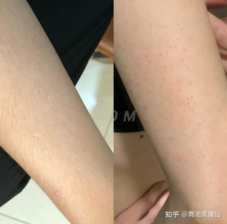 鸡皮肤还有腿毛(鸡皮肤腿毛长出来了)