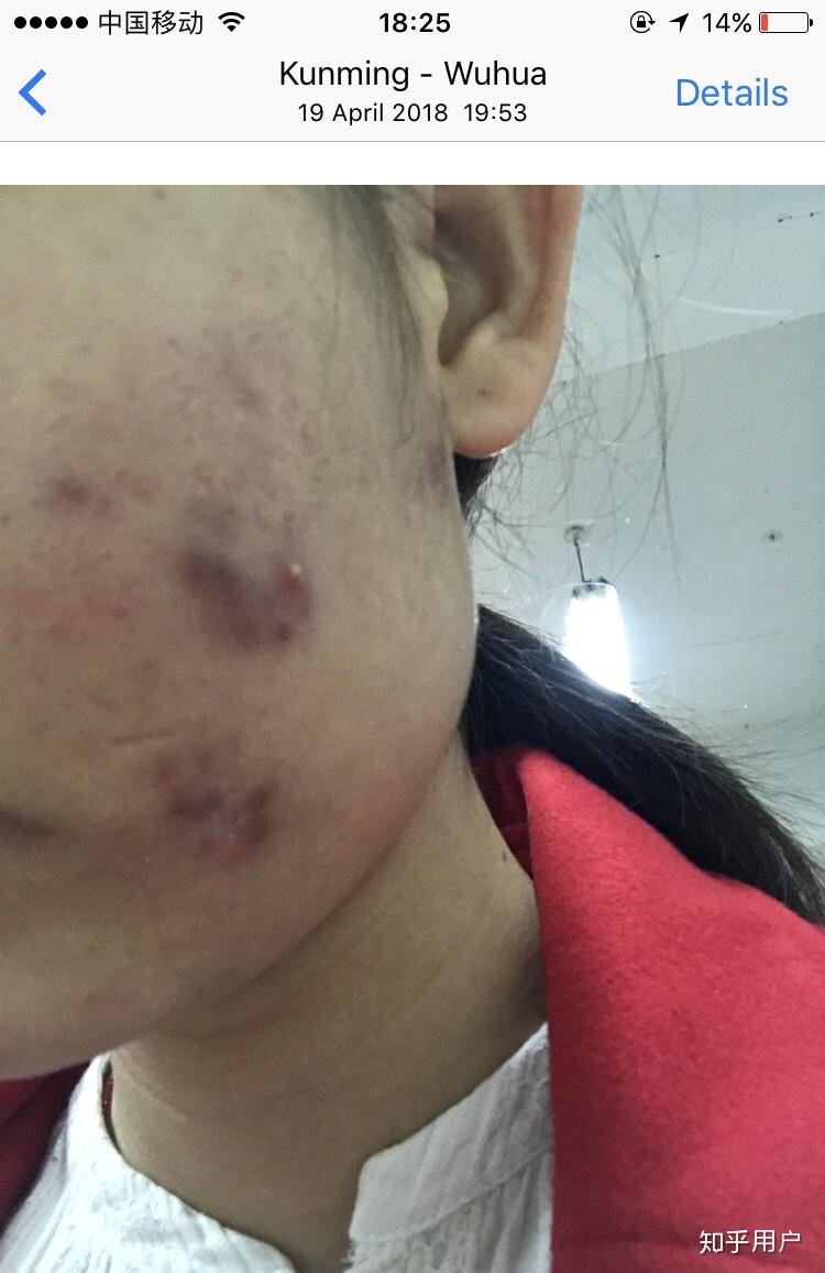 囊肿型痘痘怎么消下去? - 知乎