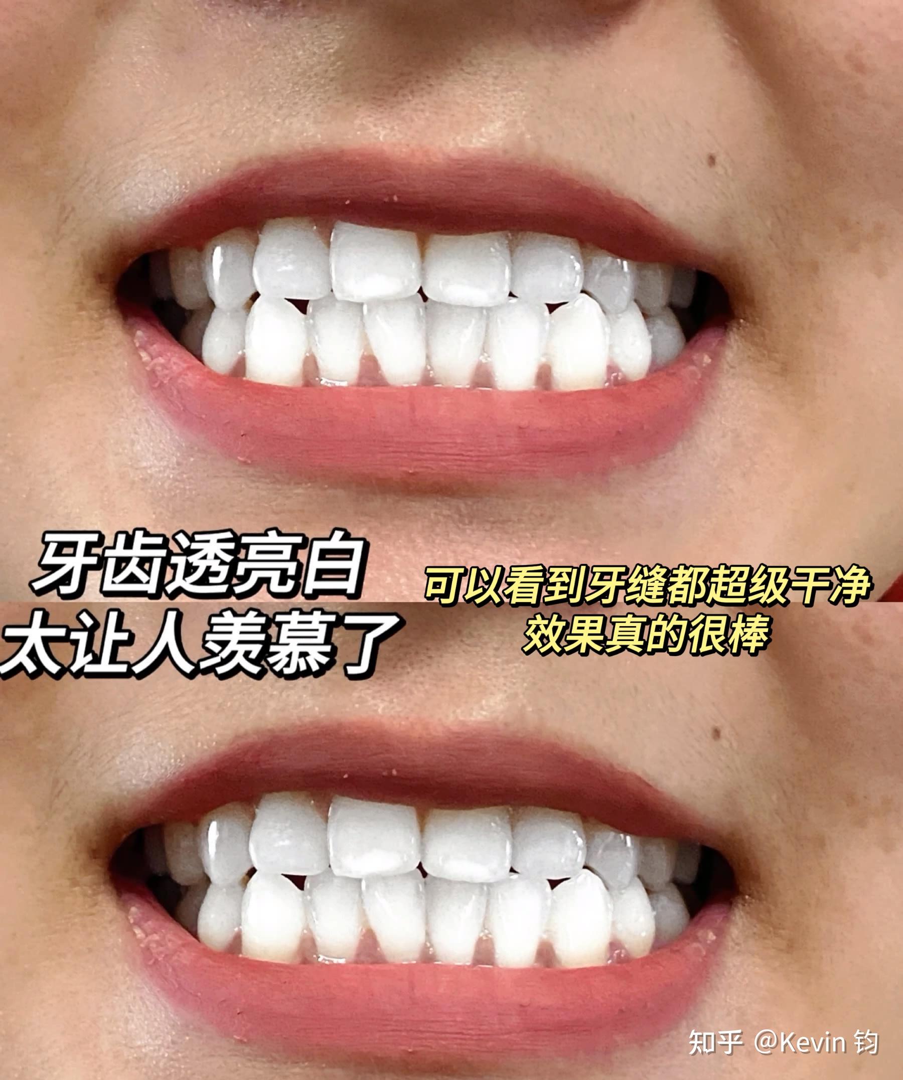 梦境解析，上牙一颗牙齿断掉——寓意与心理解析的深度探索