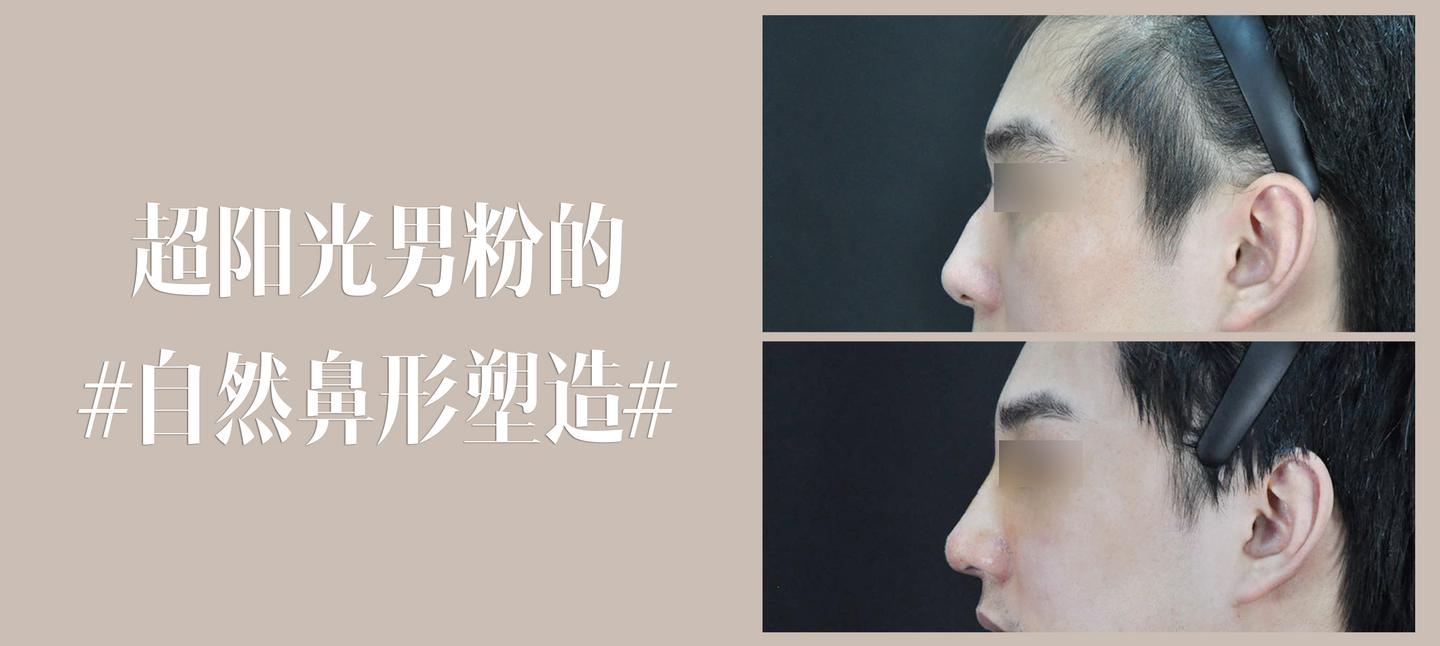 刘亦菲的驼峰鼻好看 我的驼峰鼻就惨了 知乎 刘亦菲的驼峰鼻好看 我的驼峰鼻就惨了 知乎