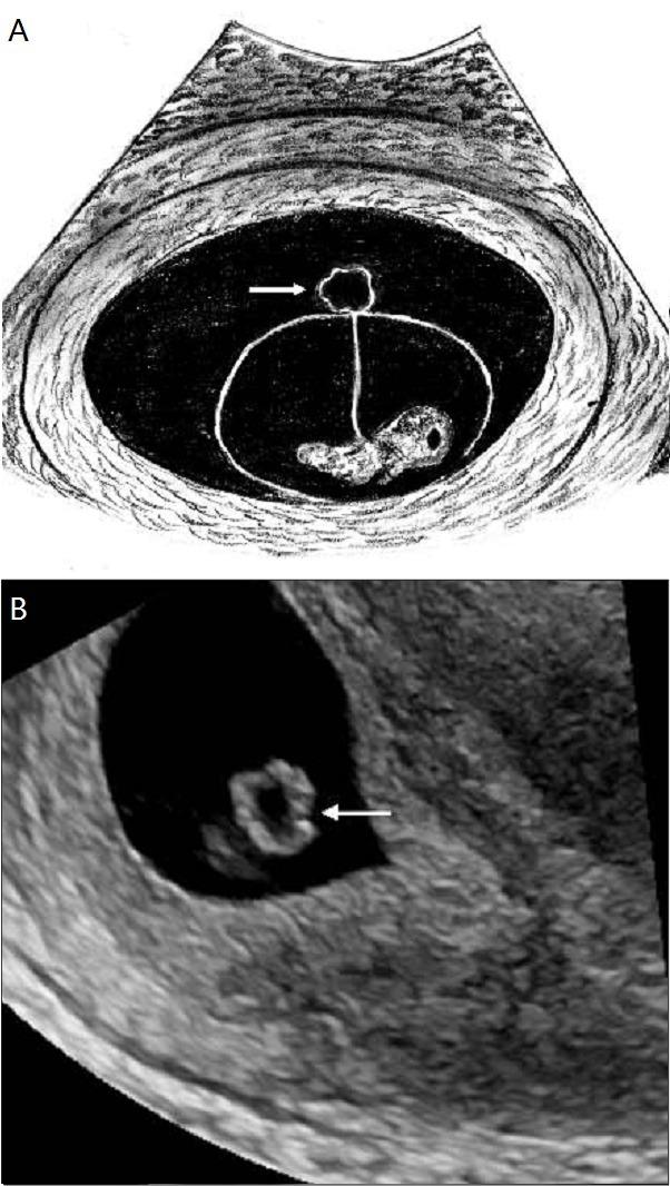 图 b 为妊娠 6 6 周经阴道超声显示存活胚胎及不规则的卵黄囊图 12