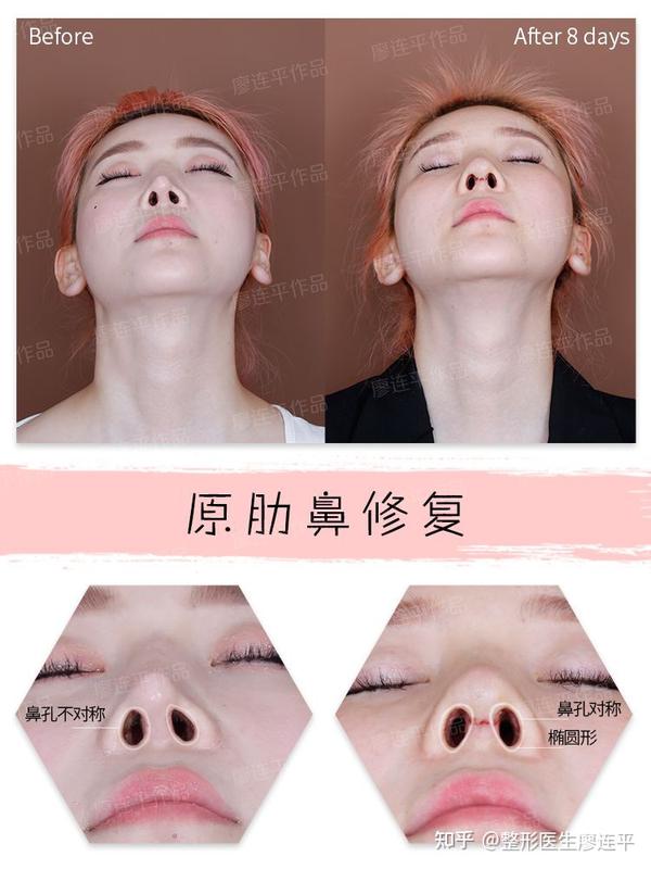 为什么说鼻孔是鼻整形最难的?鼻孔的标准形态是? - 知乎