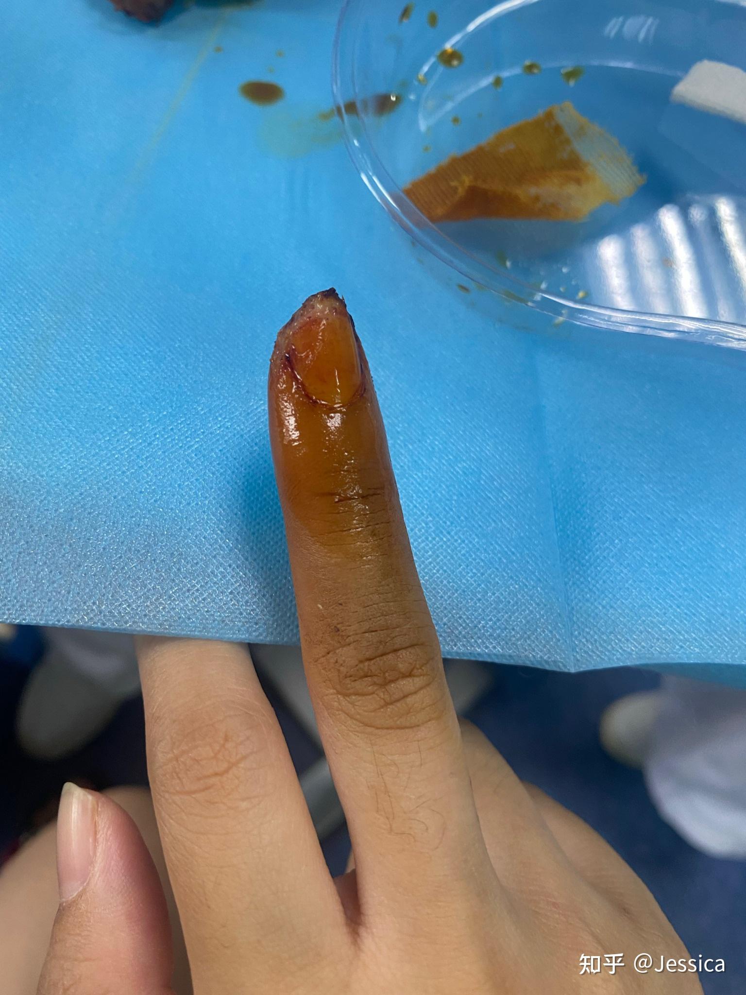 手指被割掉一块肉是什么体验? - 知乎