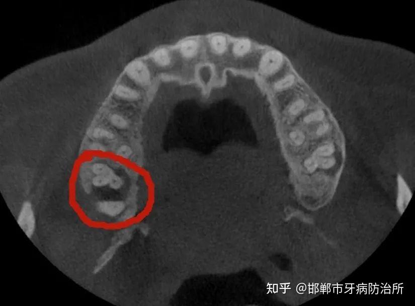 好在近水楼台,请慧芳医生拍ct,检查,确诊左上7根尖炎合并慢性牙髓炎