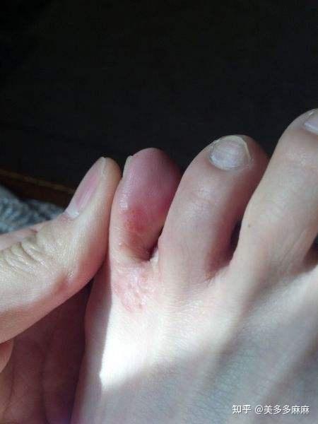 脚气到什么样子? - 知乎