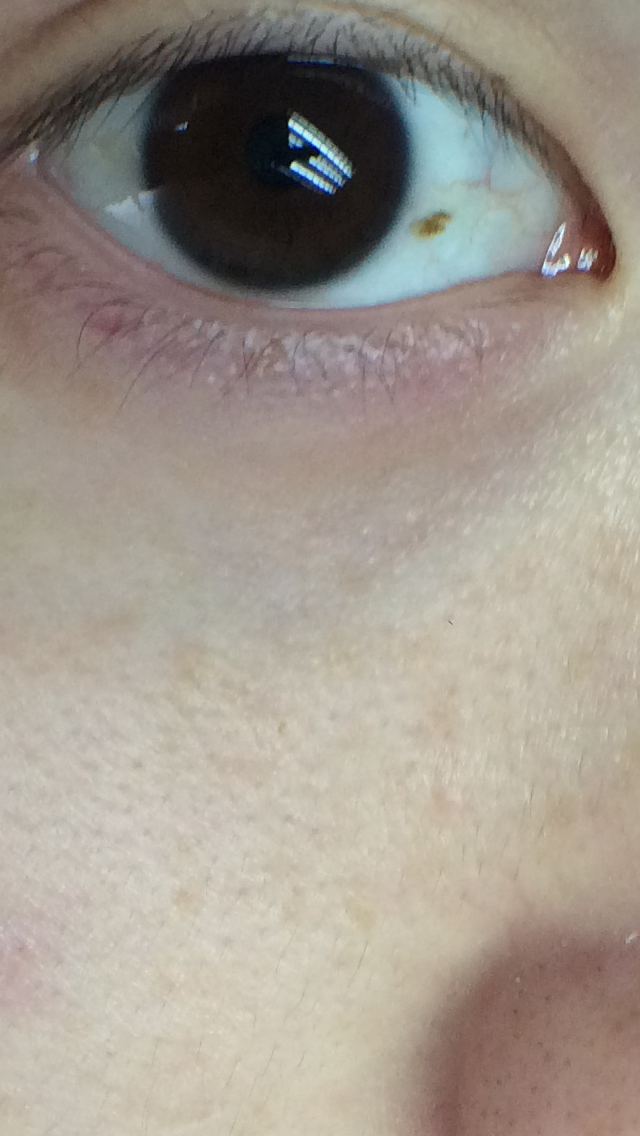 眼睛的眼白有色素沉着,并且由于时间的推移已经接近眼黑?