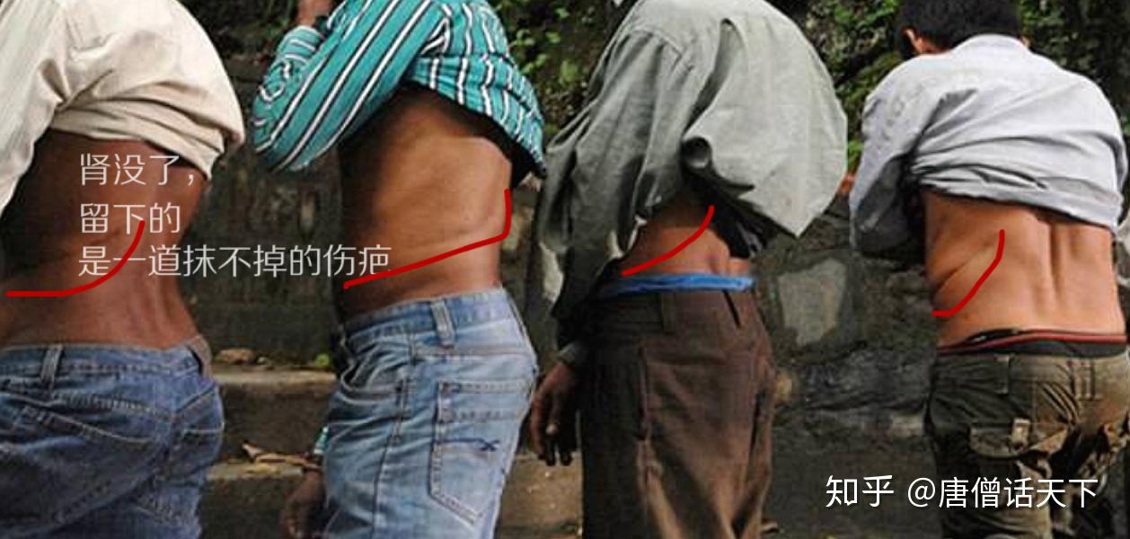 有些卖肾的人,由于伤口没有处理好,伤口化脓腐烂,最后只能瘫痪在床.