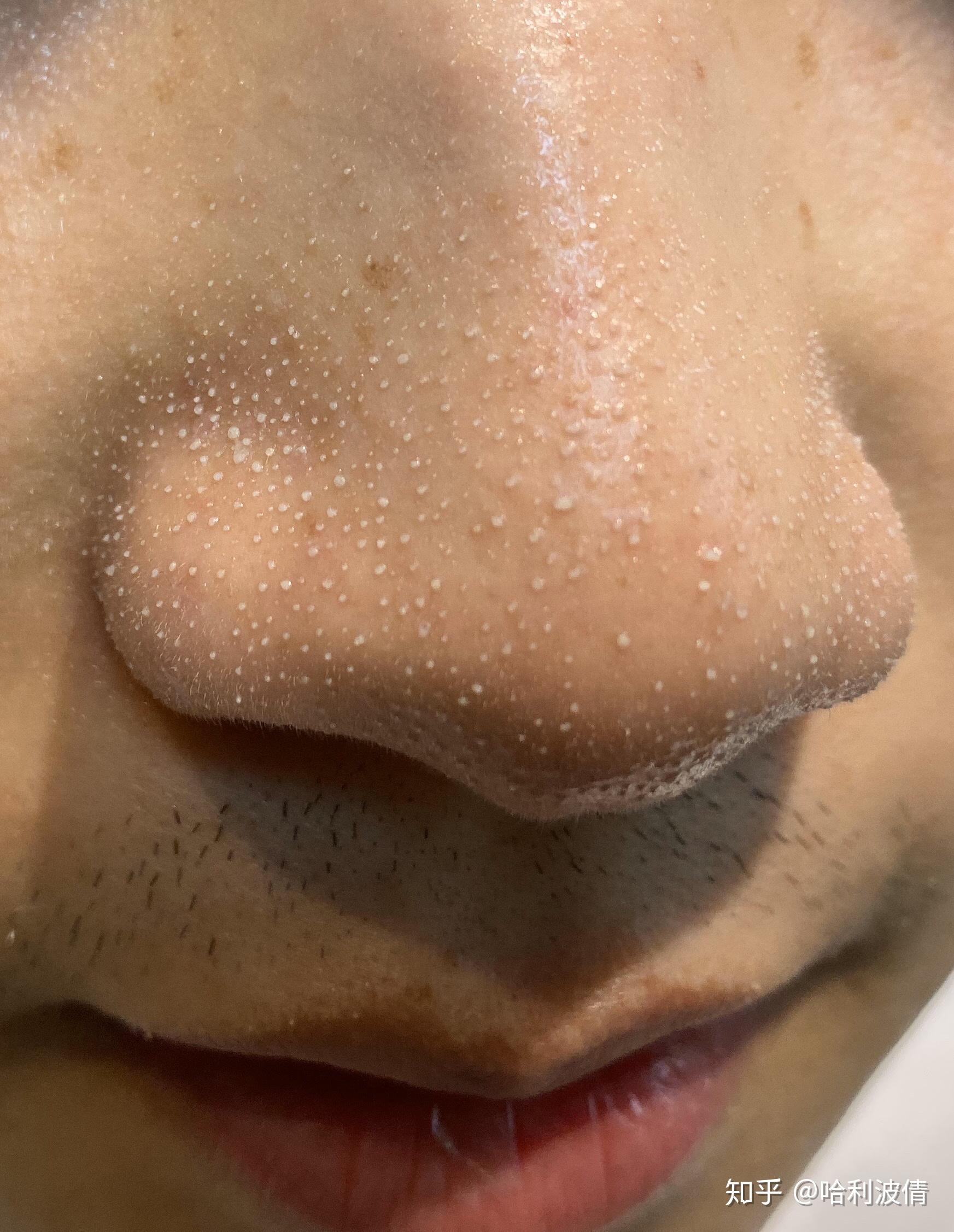 妮玛这个脂质微丝到底是个啥玩意