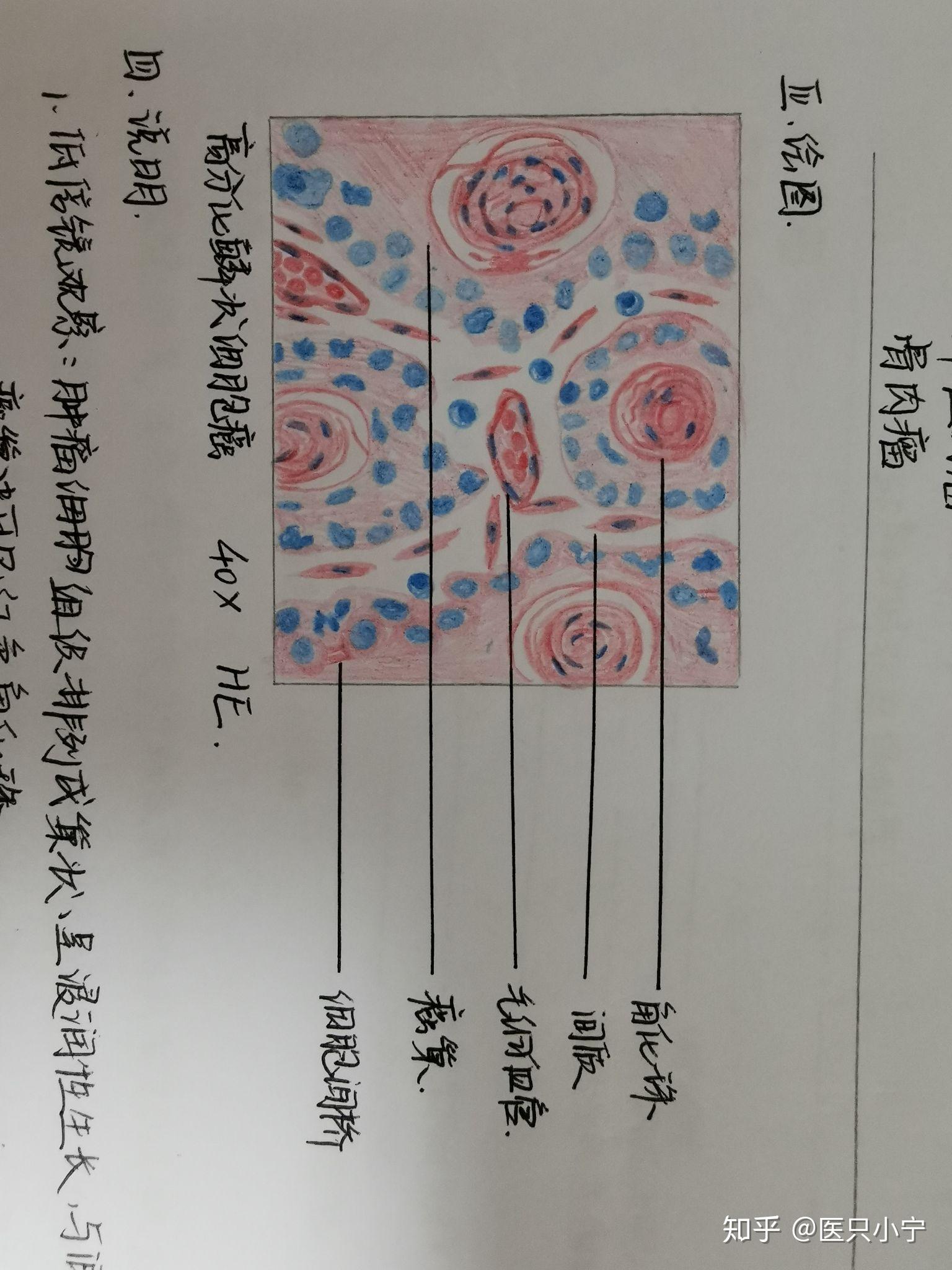 异物巨细胞红蓝铅笔图图片