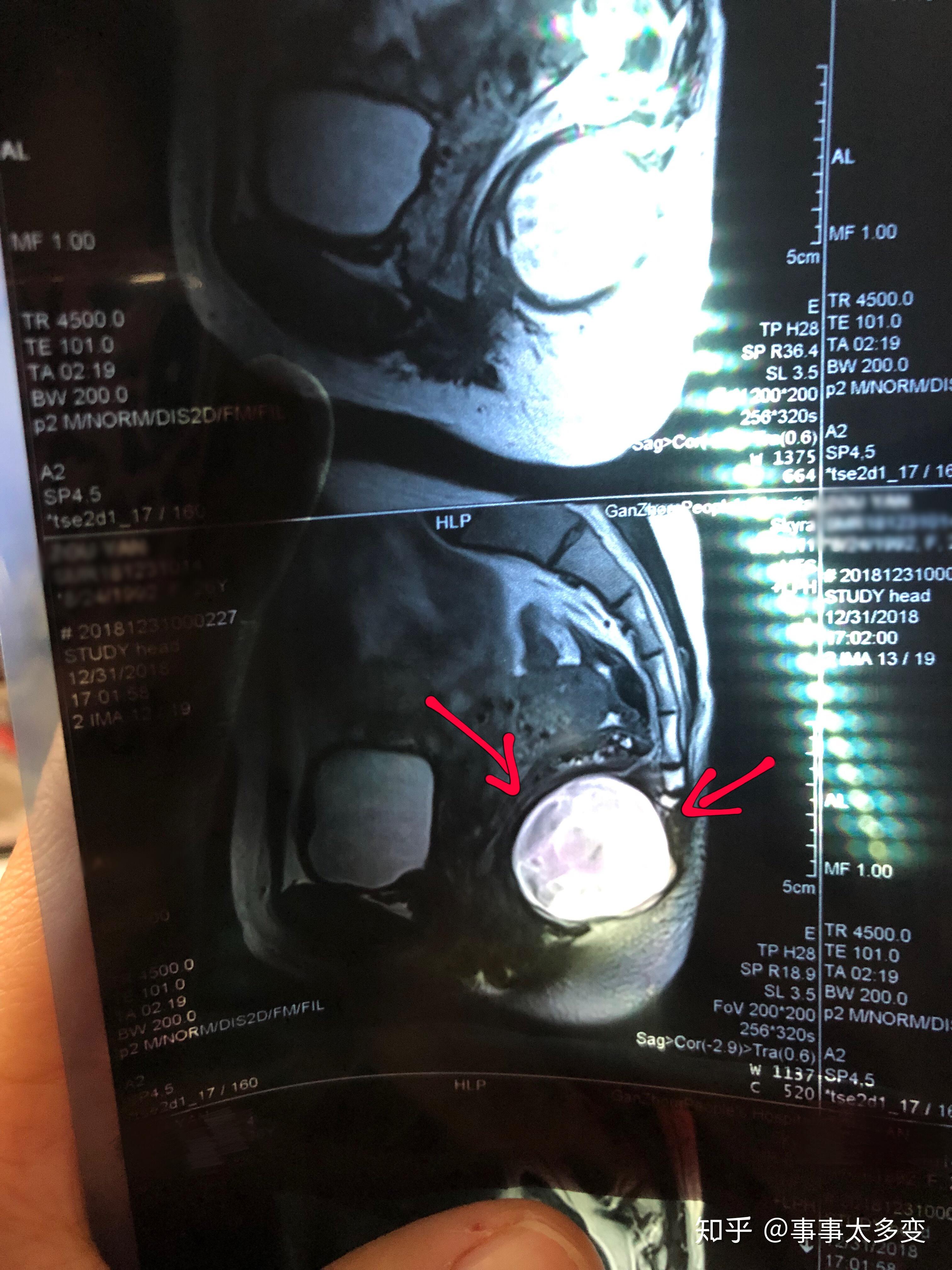 磁共振（MRI）骶尾椎扫描技术 - 知乎