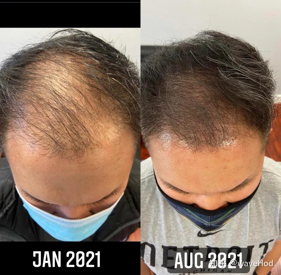 非那雄胺米诺地尔微针滚轮电动生发3例更新2021年8月