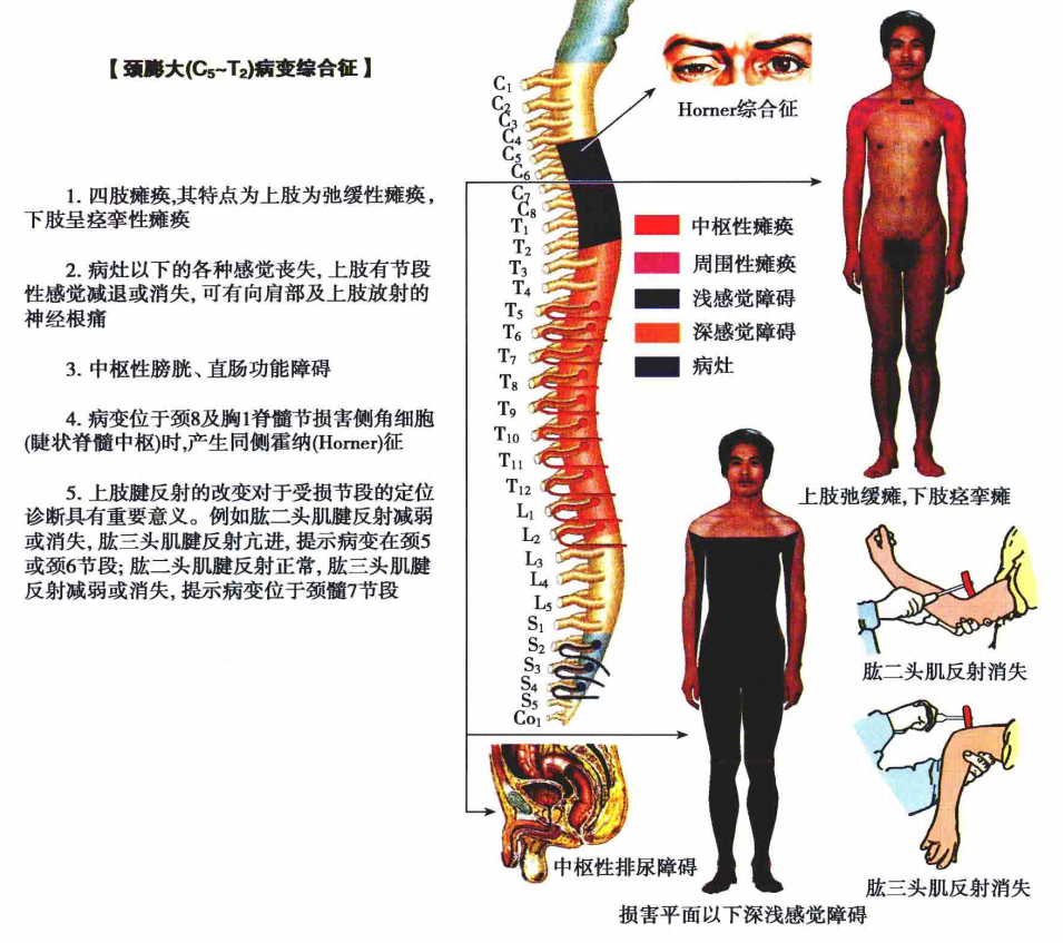 脊髓损伤分布图图片