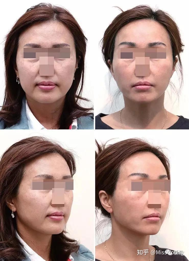 线雕埋线都有哪些后遗症? - 知乎