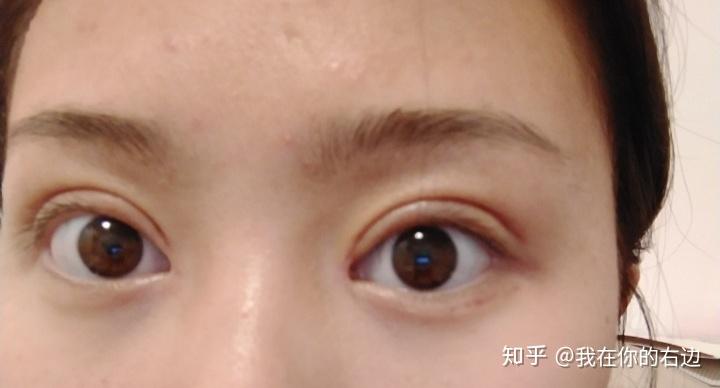 埋线双眼皮后有肉条感怎么样调整心态