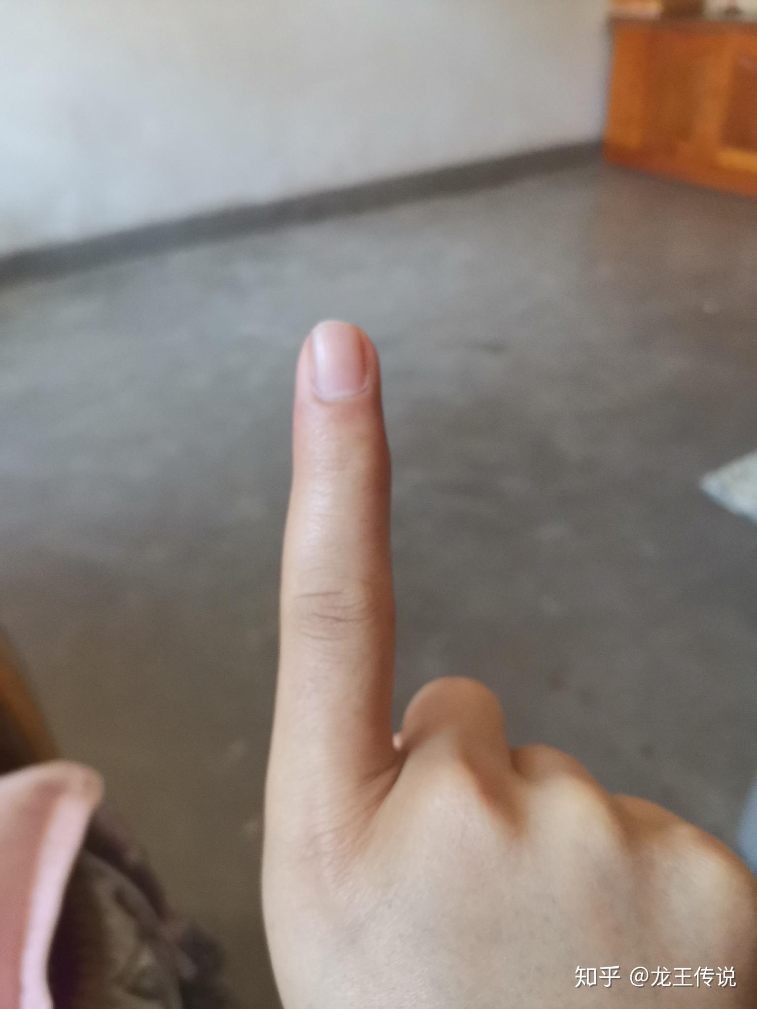 中指因为写字变形有什么方法