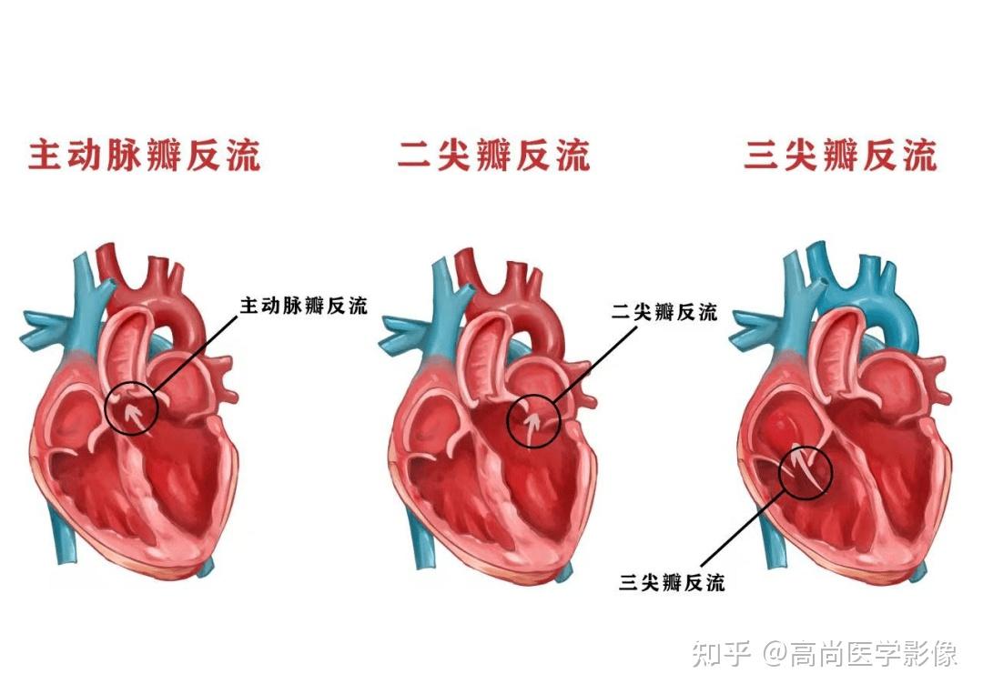 心臟二尖瓣三尖瓣輕度反流是怎麼回事