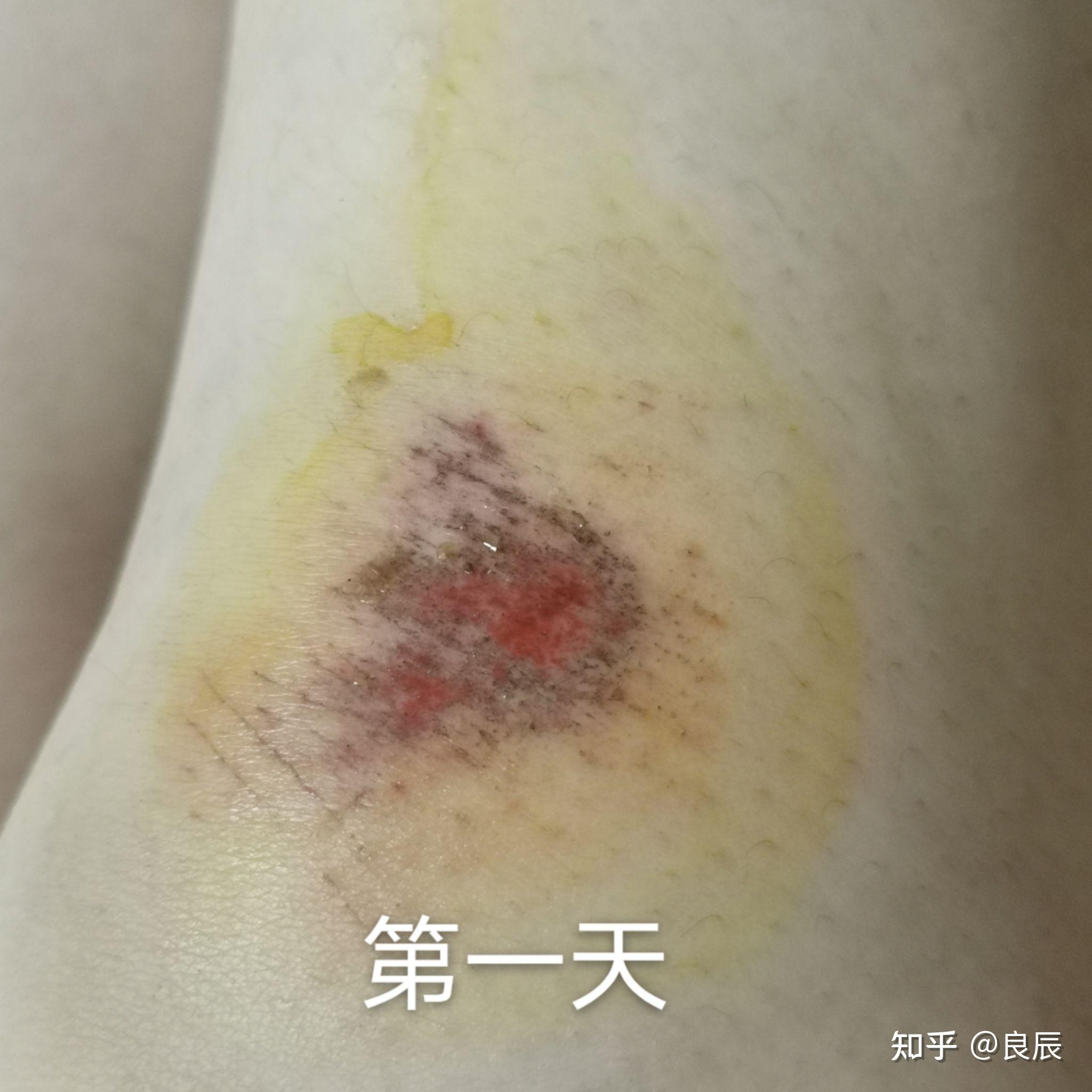 摔跤破皮后究竟如何正确处理? - 知乎
