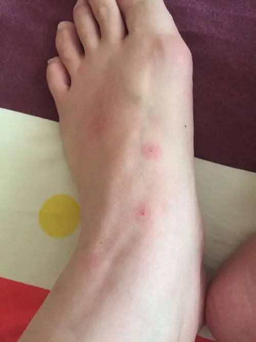 脚上越抓越痒有小疙瘩肿了 - 知乎