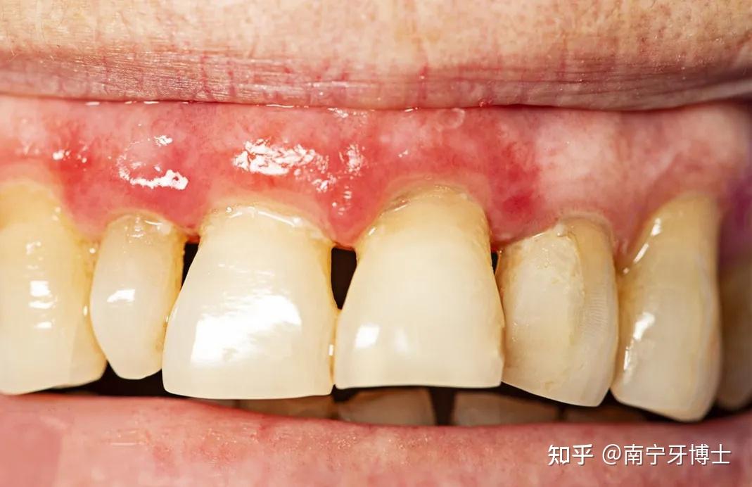 牙缝太大变身超级塞牙人应该怎么办