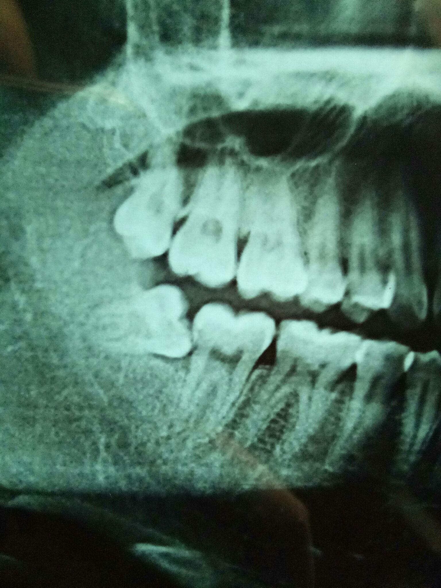 咨询各位大神水平阻生齿的问题呀?