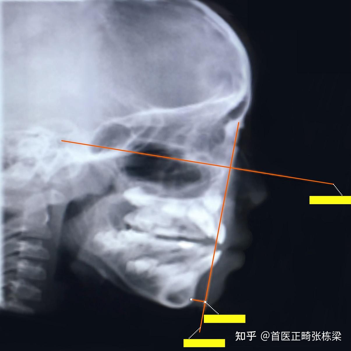 儿童“地包天”什么时候矫正干预好?深度解读! - 知乎