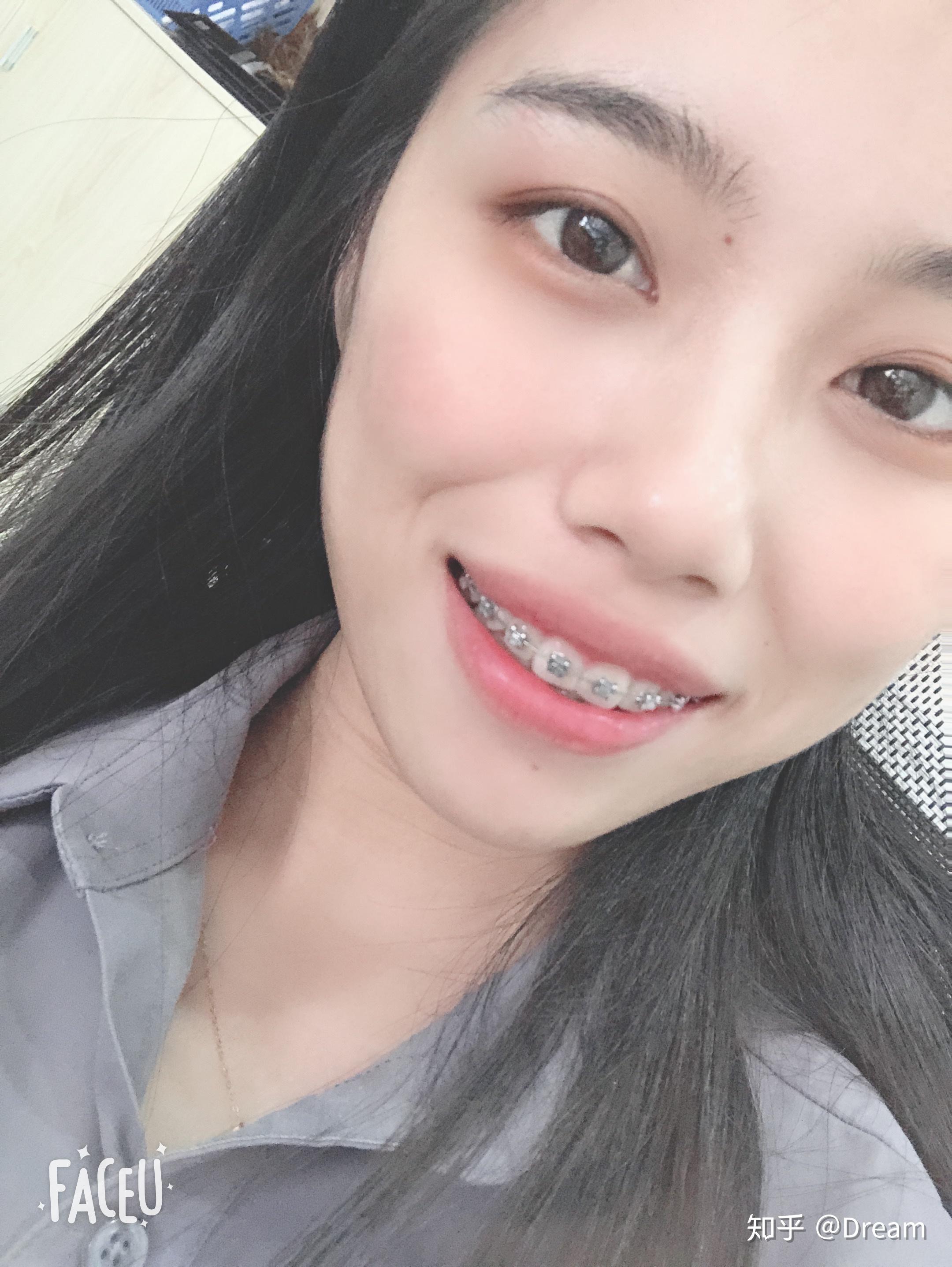 龅牙凸嘴怎么改善侧脸? - 知乎