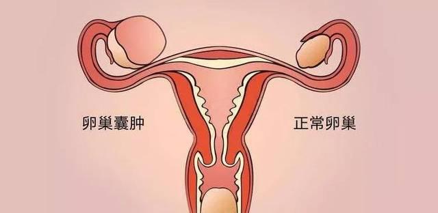 卵巢囊腫是什麼原因引起的?怎樣快速治療,預防卵巢囊腫.