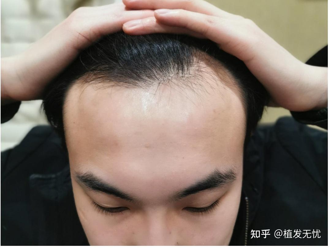 包含植发哪里好认准雍禾植发的词条