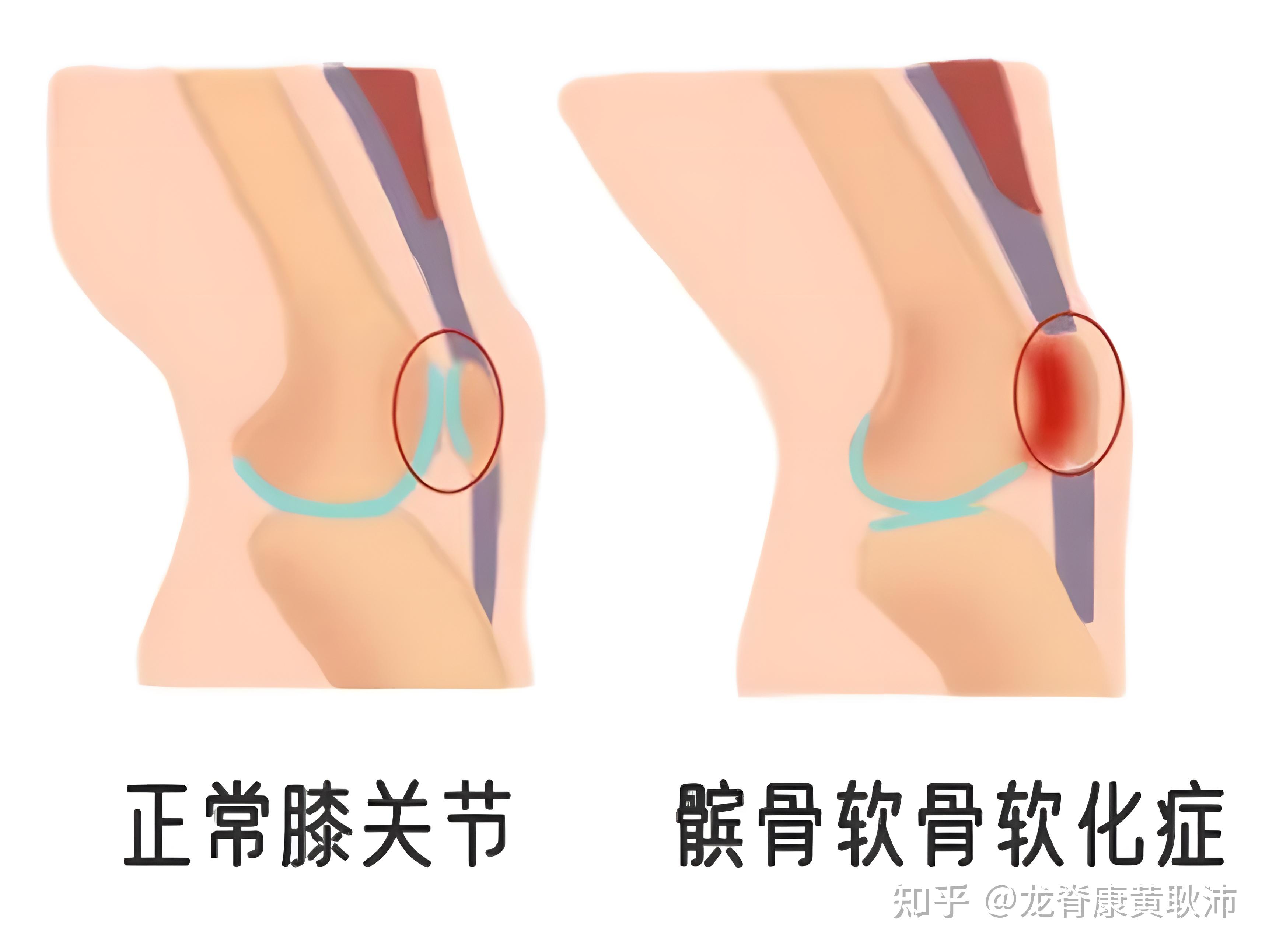 常见运动损伤处理清单,康复医生帮您整理好了!