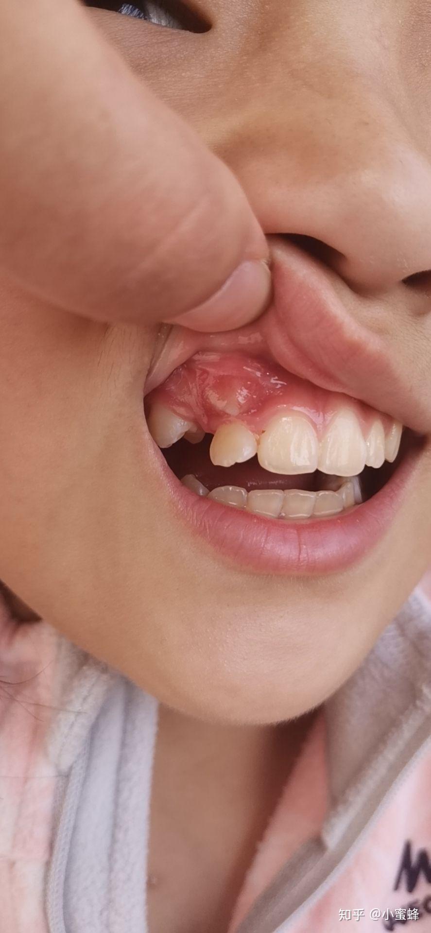 儿童牙龈上长牙齿图片图片