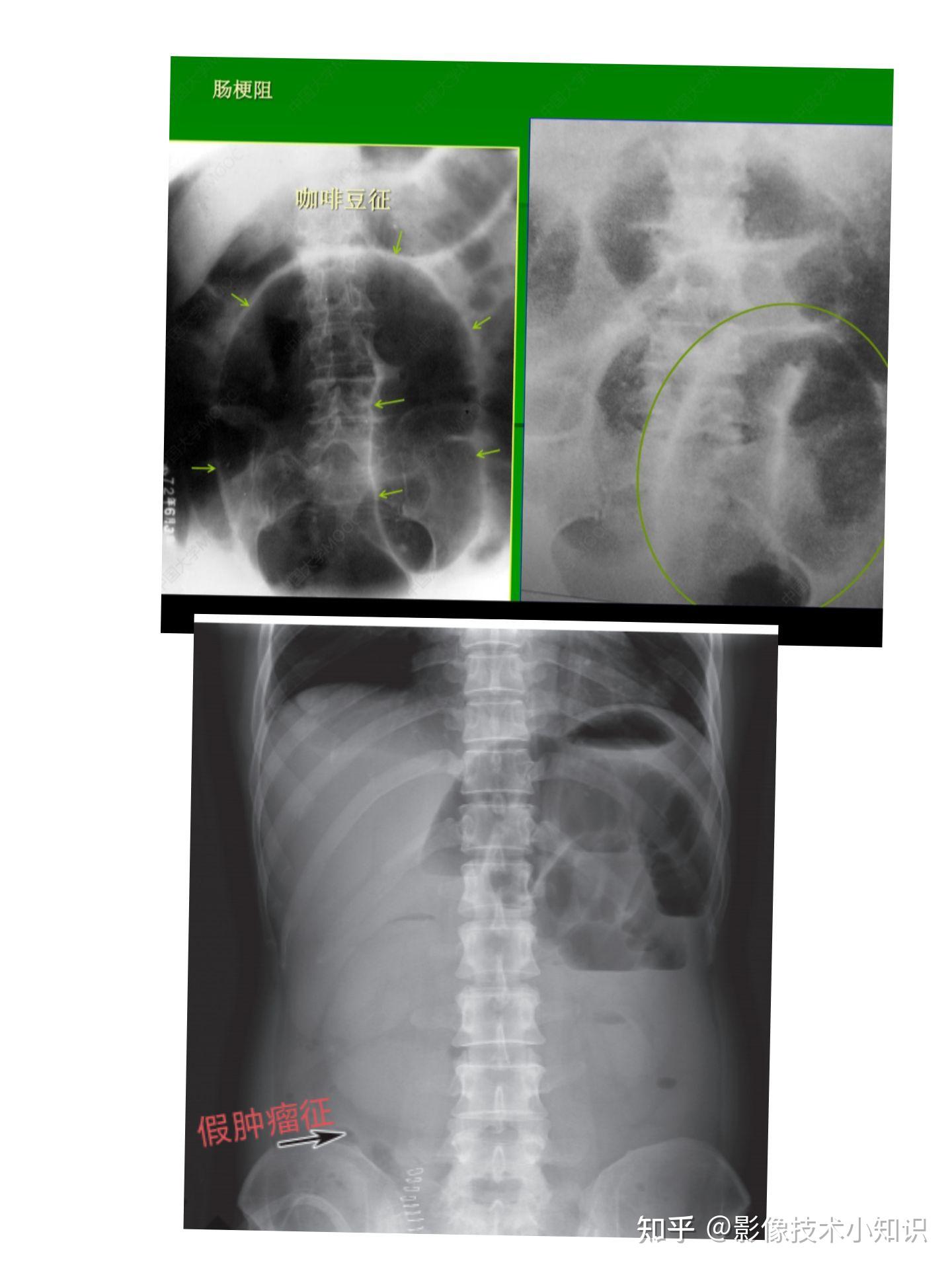 肠梗阻x线表现图片图片