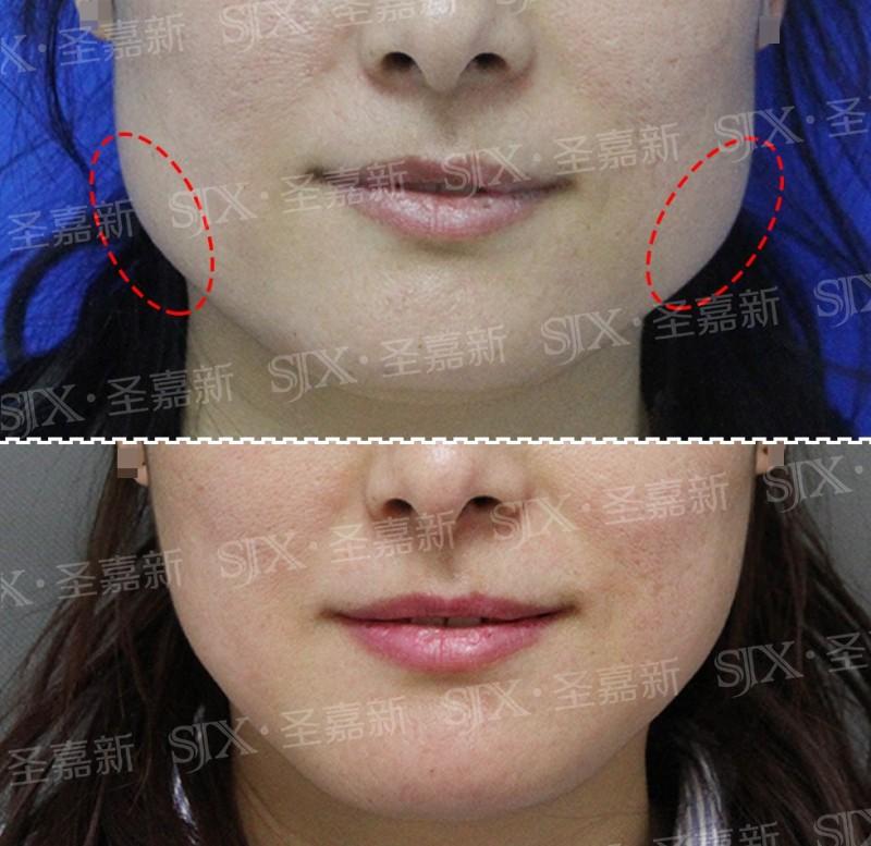 比国字脸更大的梯形脸应该怎么瘦脸