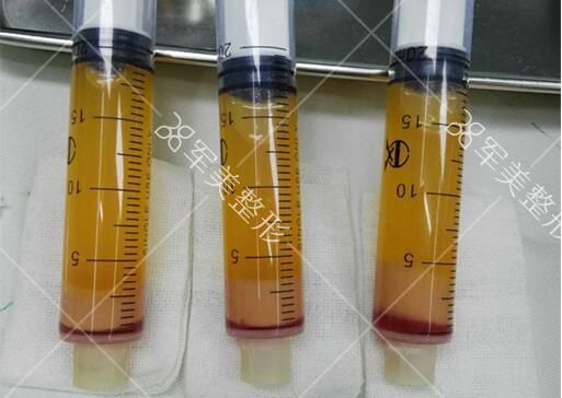 ECM/SVF-GEL：自体脂肪移植进入再生修复的2.0时代 - 知乎