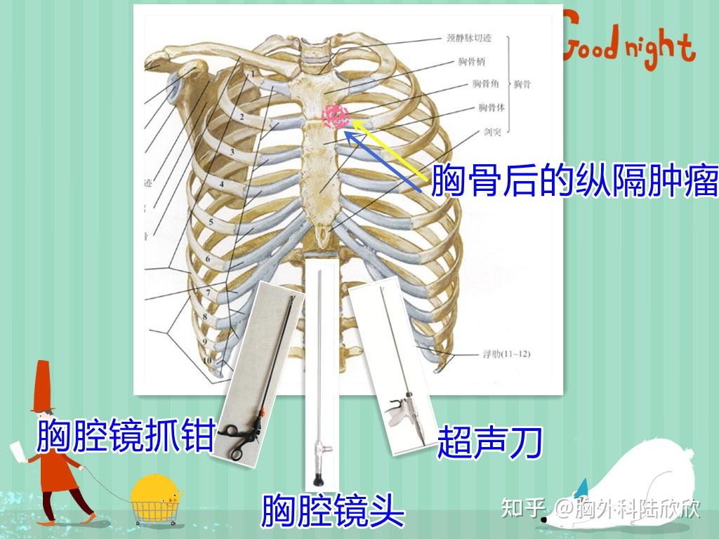 切胸手术图解图片