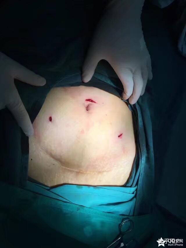 女人手术腹部图片
