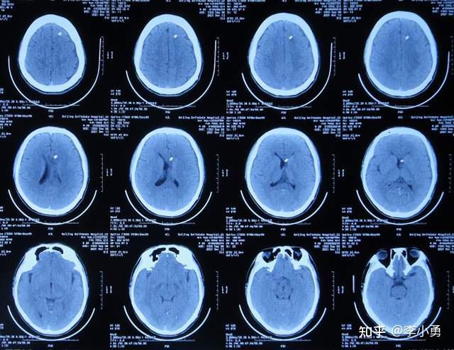 结核脑膜炎性脑积水外院治11天无效后,及早直接转来李小勇脑脊液科治