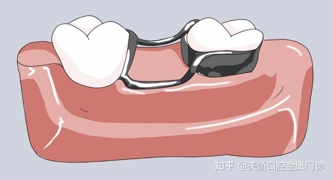 儿童乳牙预成冠可以恢复乳磨牙的咀嚼功能及正常咬合关系,防止充填物