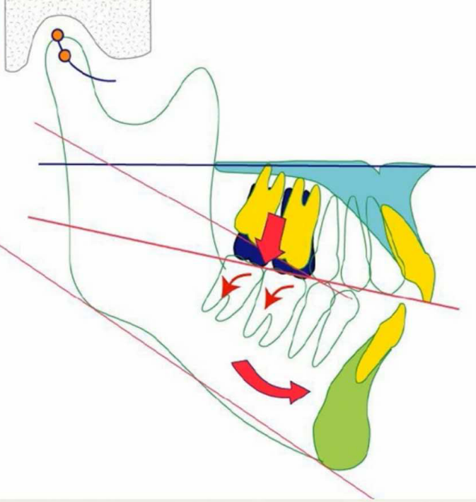 能不能推下磨牙向后,整体下排牙向后,上排牙不动,为了正常咬合,下巴不