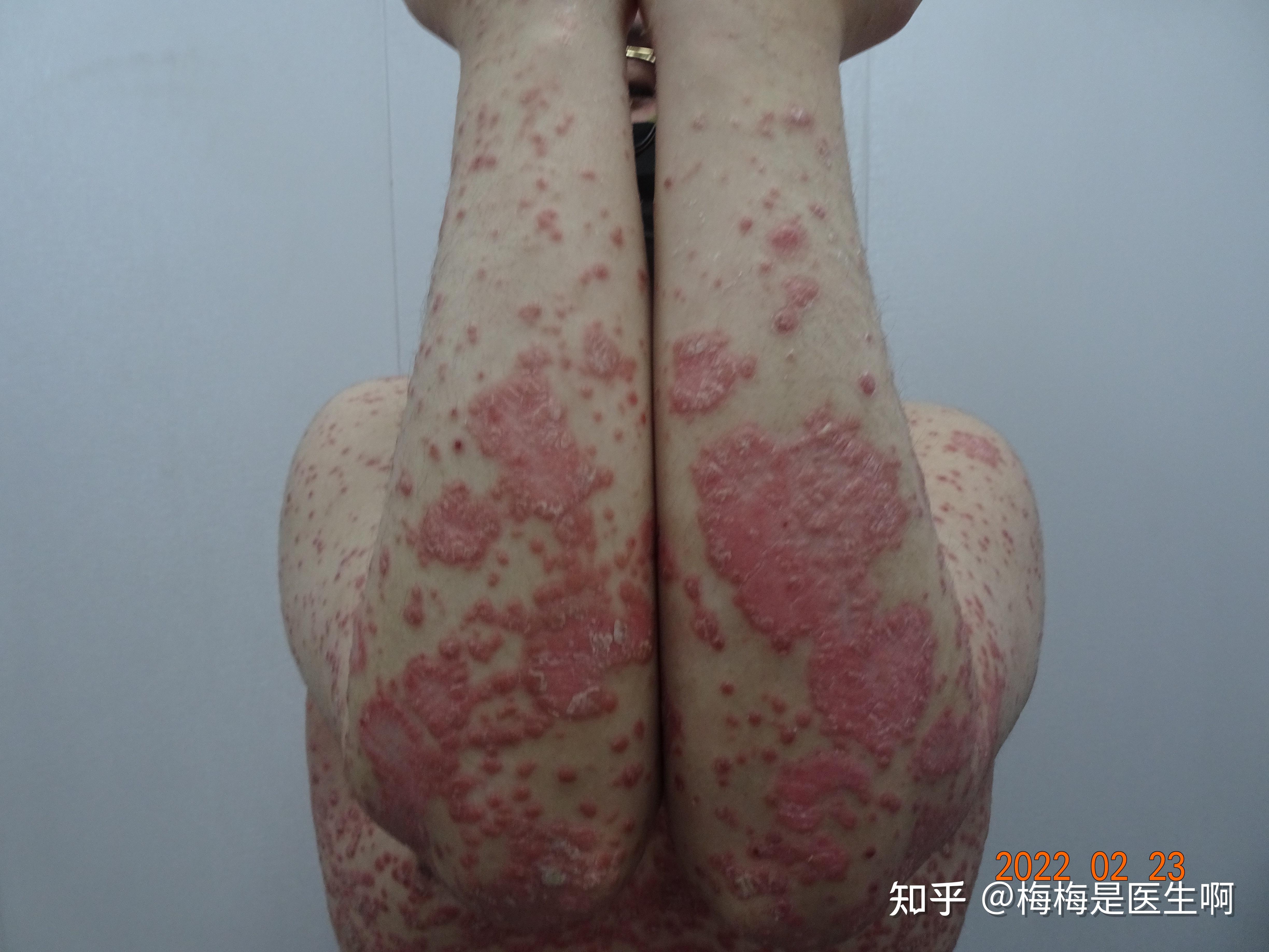 皮肤变化让护士倒吸一口冷气 | 全身银屑病 | 激素药 | 密集恐惧