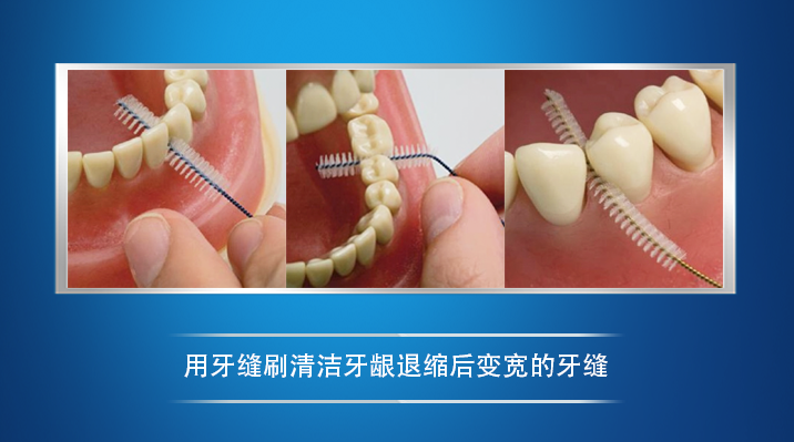 针对牙肉萎缩,变宽的牙缝,牙线也变得清洁不力,此时应使用牙缝刷(图5)